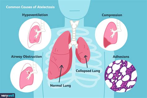 What Causes Lung Deflation